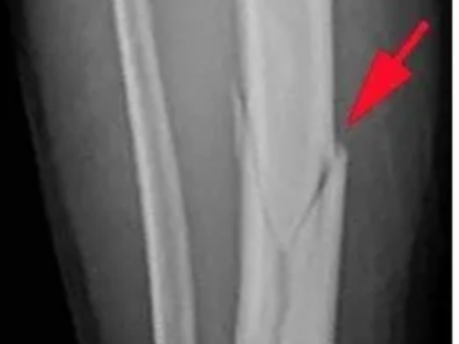 A Broken leg Left Me Unable to Walk — Please Help